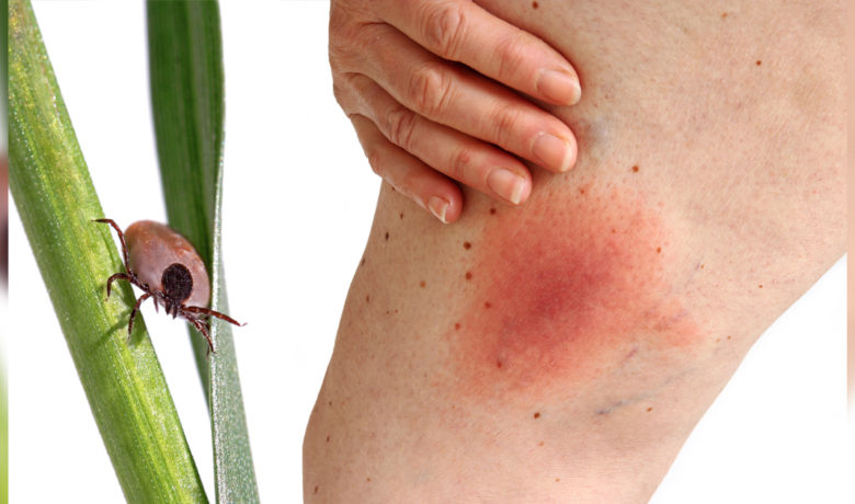 Colorado Tick Fever Cases on the Rise in Wyoming